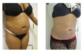 Before and after of abdomen liposuction by Dr. Drew Varano in Washington DC